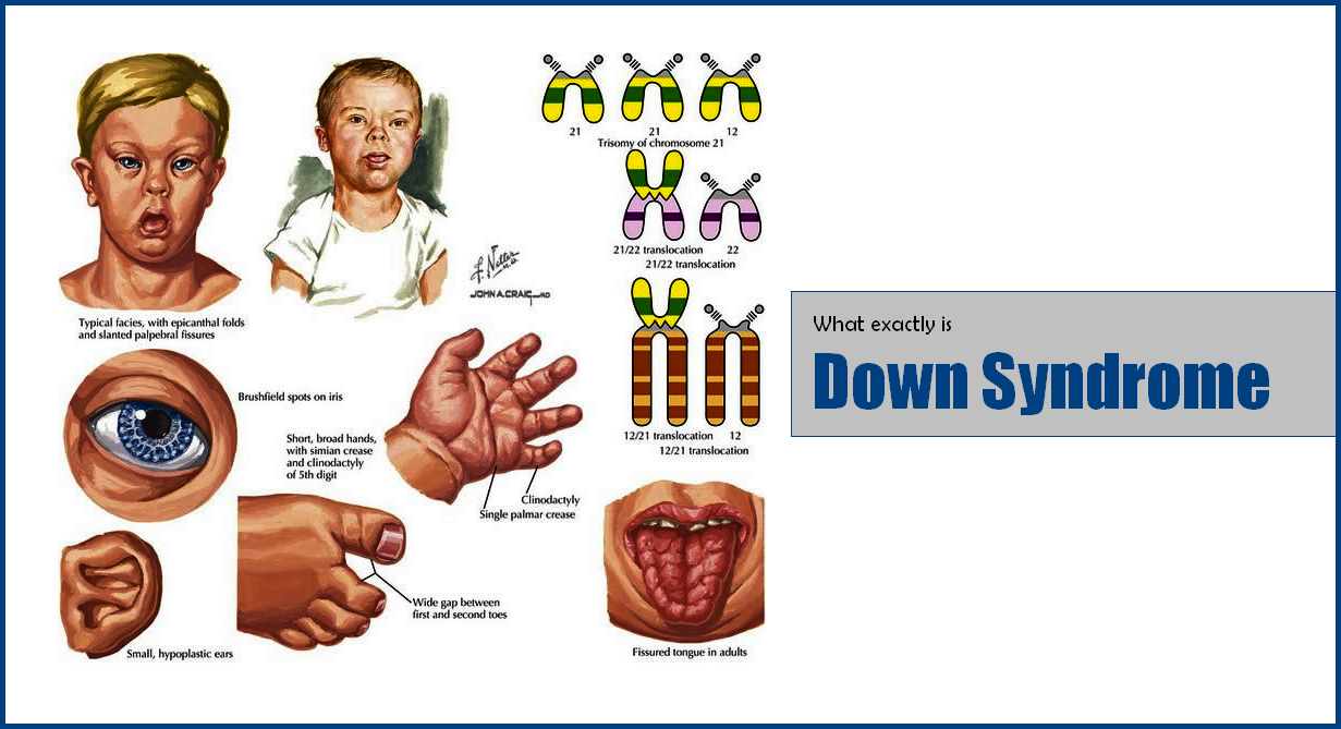 what exactly down syndrome